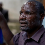 Jean Kakuru Biyambo, from the Muja internally displaced persons camp, is seen at the Goma General Hospital where he has been receiving treatment against mpox in North Kivu province, Democratic Republic of Congo